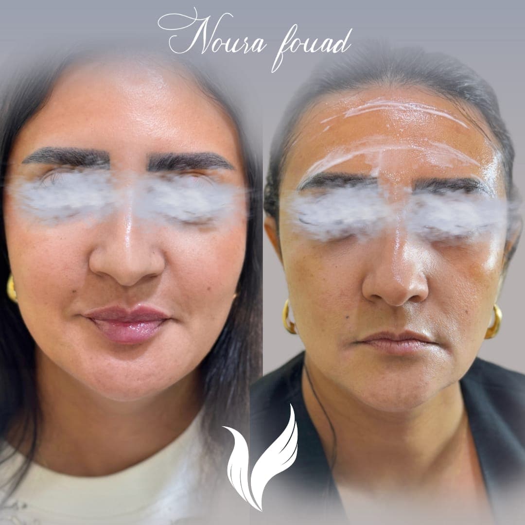 Patient result — PRP Therapy