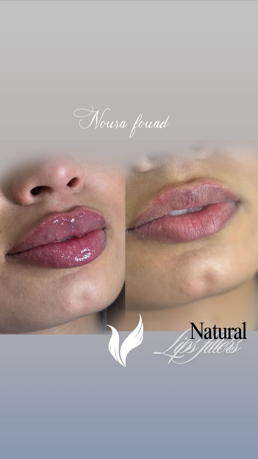 Restoration & Refinement treatment