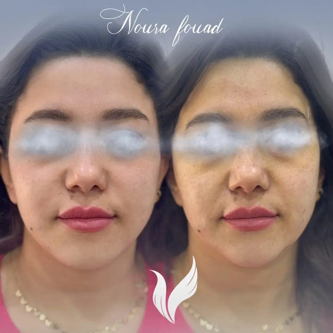 Patient result — Skin Booster